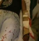  Hombre celoso le corta una mano a su ex concubina en Gaspar Hernández